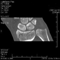 tomografia computadorizada coronal (CT) demonstrar ...