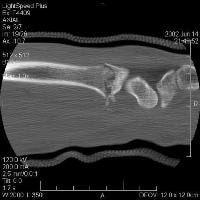 Sagital tomografia computadorizada (TC) demonstrando ...