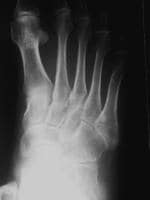 metatarsal fracture fragment 3 mm displaced
