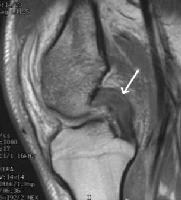 Torn Lcl Mri