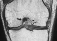 pcl injury mri