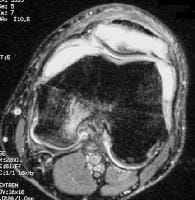 Patella Contusion