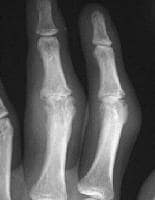 Hand Rheumatoid Arthritis
