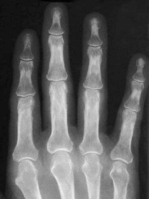  joints in a patient with rheumatoid arthritis of the hands.
