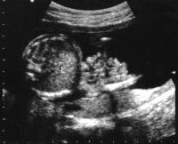 ultrasound gastroschisis