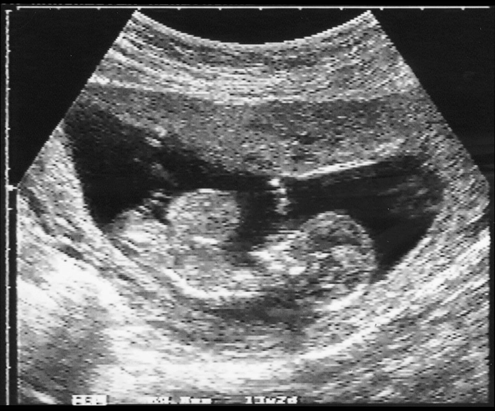 Пупочная грыжа эмбриона на УЗИ 10 недель