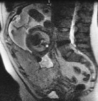 pathophysiology of placenta previa pdf