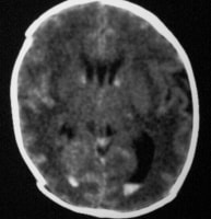 Subependymal Hemorrhage