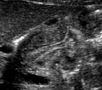 Longitudinal ultrasonogram in a patient with hypertrophic pyloric stenosis 
