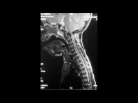 Achondroplasia. Sagittal section of the cervical s