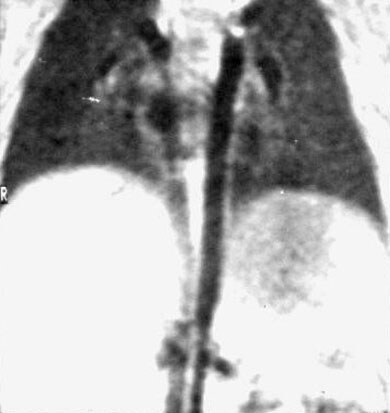 Inferior Vena Cava. of the inferior vena cava.