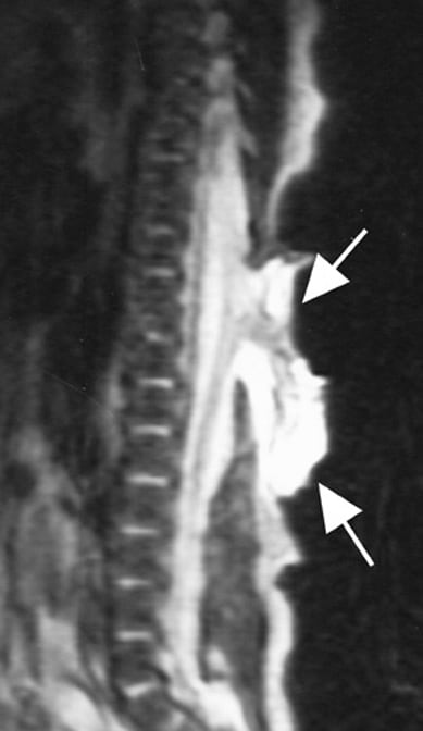 The spinal cord, in addition