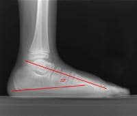 club foot xray