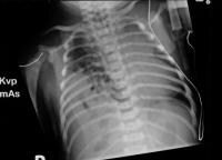 Radiografia de tórax ântero-posterior (AP) de um direito ...