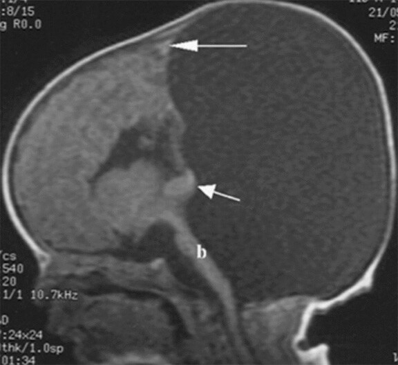 Dandy Walker Malformation Dandy Walker Malformation