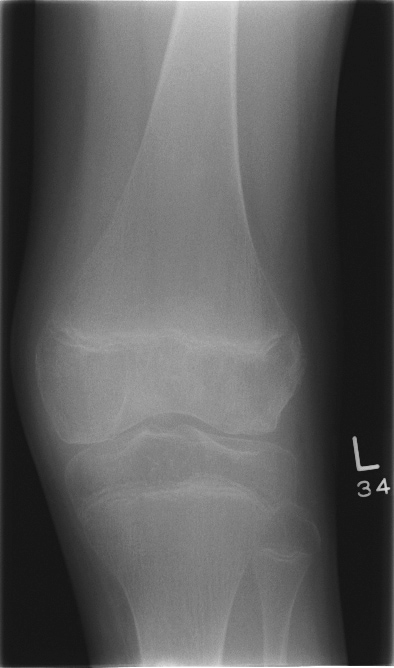 Plain radiograph of the knee shows osteopenia wit.