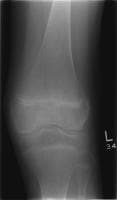 radiografia simples do joelho mostra a sagacidade osteopenia ...