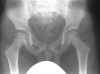 Legg-Calve-Perthes Disease Imaging Legg-Calve-Perthes Disease Imaging