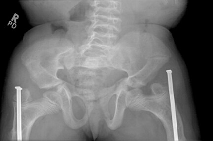 Frontal radiograph of the pelvis in a 9-year-old ...