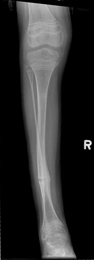 Frontal radiograph of the leg in a patient with t...
