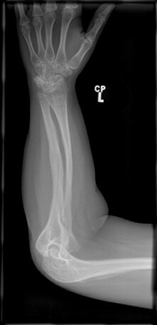 Frontal radiograph of the forearm in a 17-year-ol...