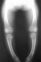 Radiograph in a 4-year-old girl with rickets depi...