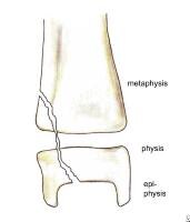 salter 1 fracture salter 1 fracture