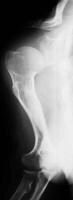 Image shows rhizomelic shortening of the humerus w