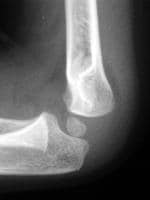 Elbow Joint Effusion