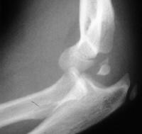 pediatric elbow dislocation