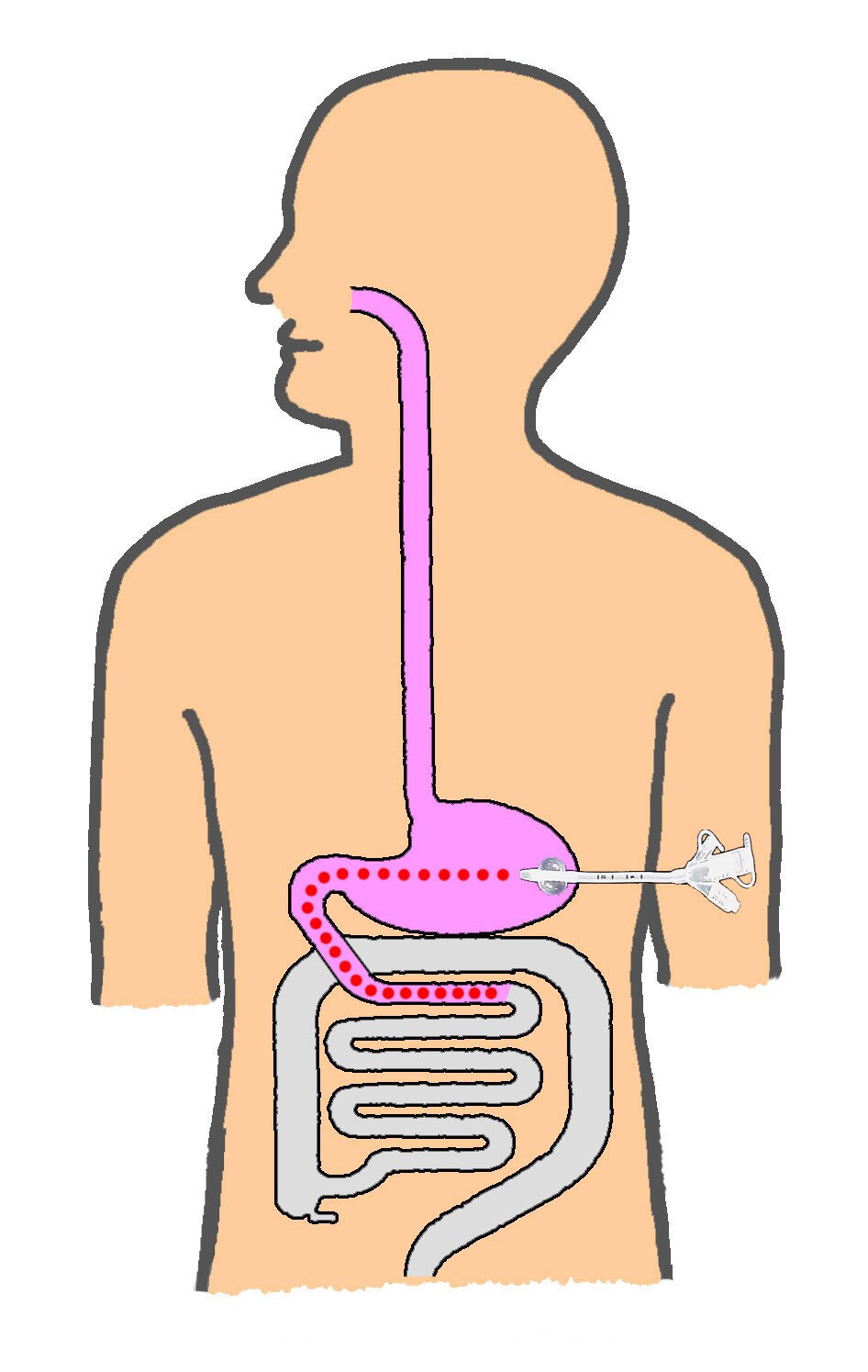 Feeding Tube Placement