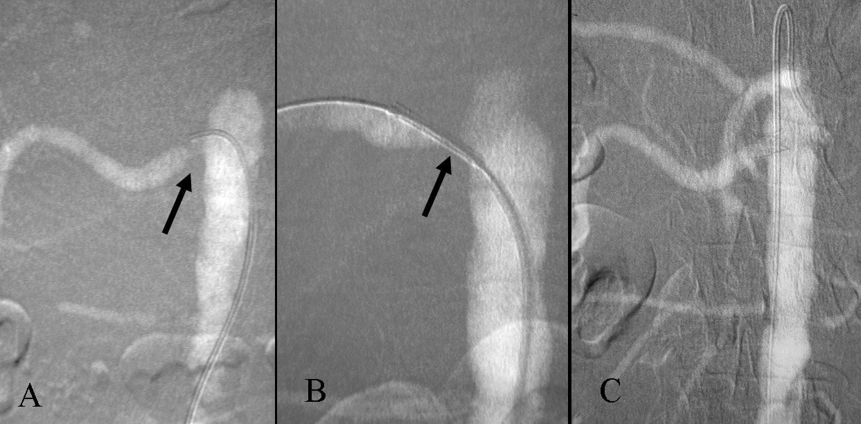 renal stenosis