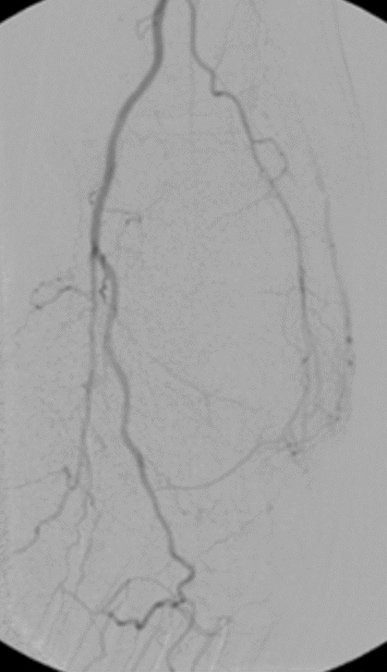 Delayed opacification of the dorsalis pedis artery (not seen) is secondary 