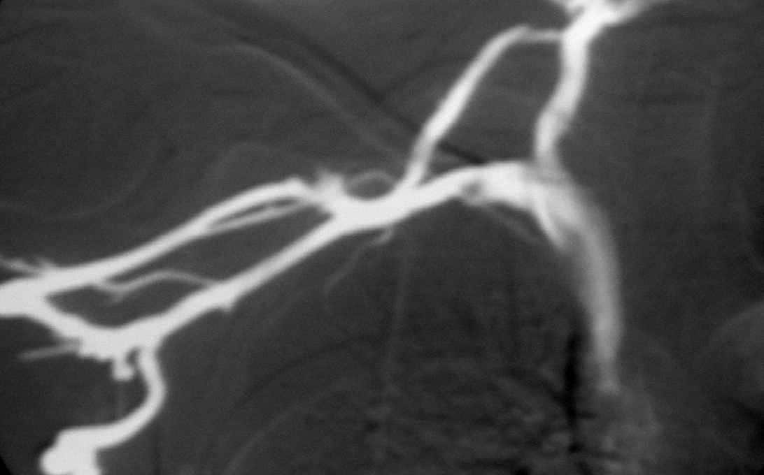 thoracic outlet syndrome vs subclavian stenosis