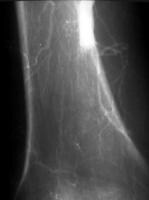 Acute Arterial Occlusion