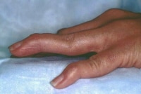 Rheumatoid changes in the hand. Photograph by Dav...