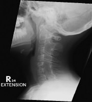 Ankylosis in the cervical spine at several levels...