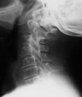 Lateral view of the cervical spine in a patient w...
