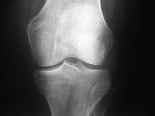 Osteoarthritis Of Knee. Osteoarthritis+knee