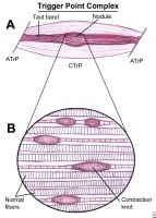 Schematic of a trigger point complex of a muscle i