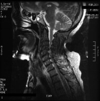 Cervical Spondylosis