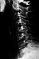 Radiograph of the cervical spine shows straighteni