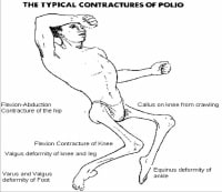 Acute Poliomyelitis