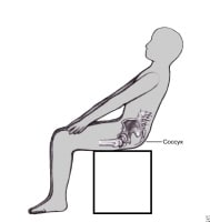 coccyx tumor