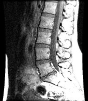 Nucleus Pulposus Herniation