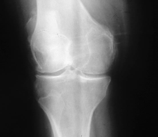 Osteoarthritis of the knee, Kellgren stage III.