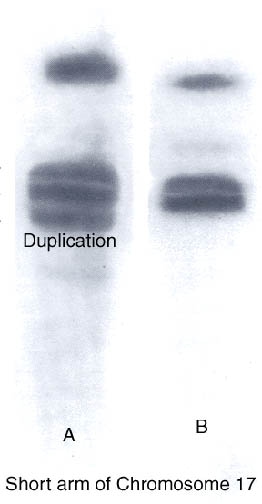 duplication of dna. type 1A DNA test showing