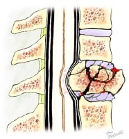 A vertebral burst fracture. 