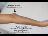 Olecranon bursitis seen with the elbow extended; t