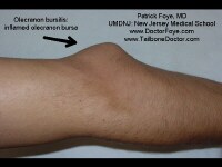 Olecranon bursitis seen with the elbow extended. I